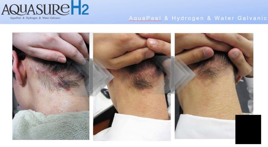 Máy Chăm Sóc Da Mặt Tổng Thể AquaSure H2 - Hàn Quốc (9)