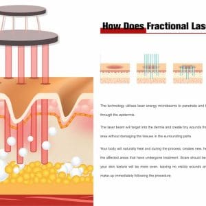 Máy Laser CO2 Fractional (laser co2 fractional