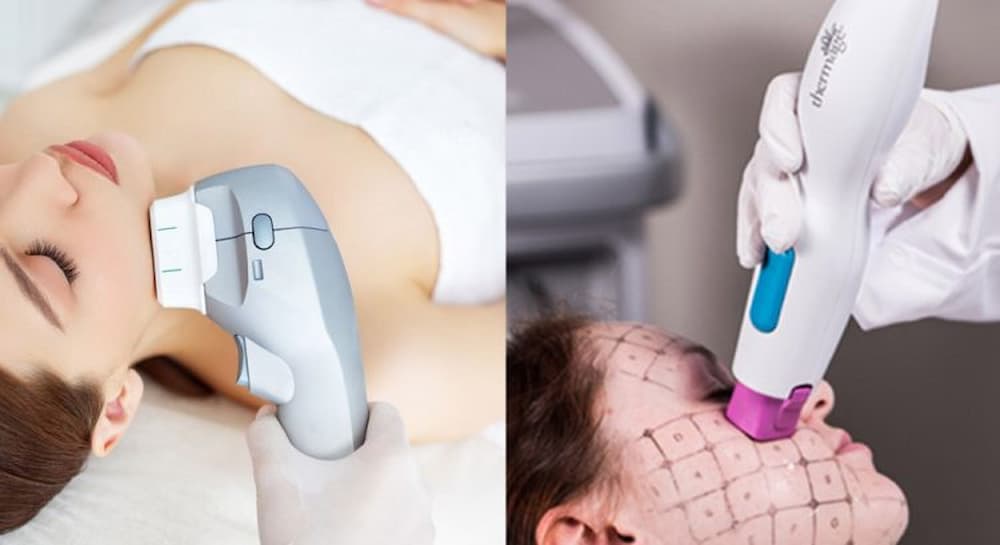 HIFU và Ultherapy