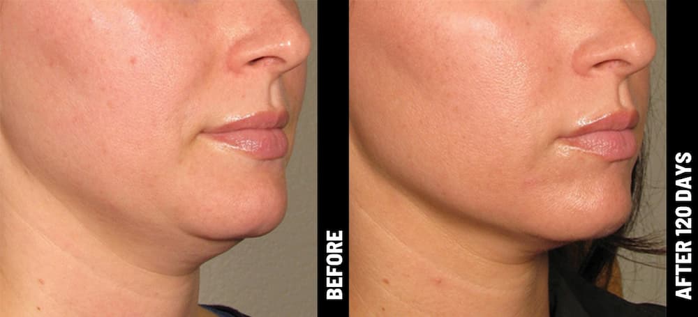 Ultherapy đặc biệt hiệu quả cho vùng cổ và cằm
