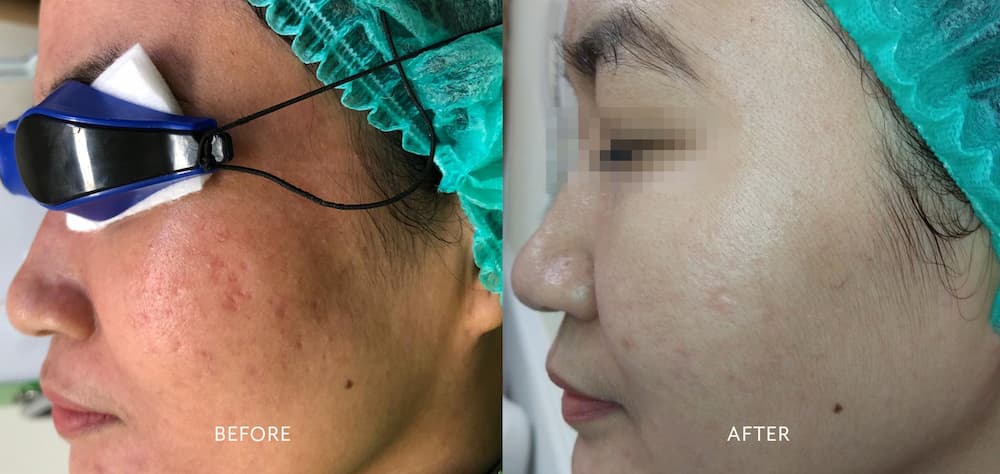 Laser co2 fractional giá bao nhiêu