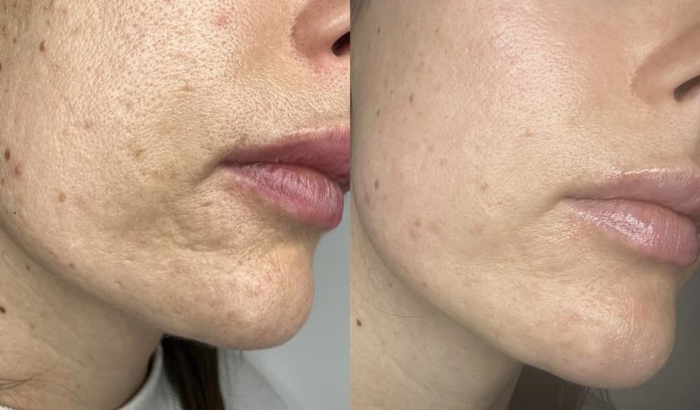 Laser co2 fractional giá bao nhiêu