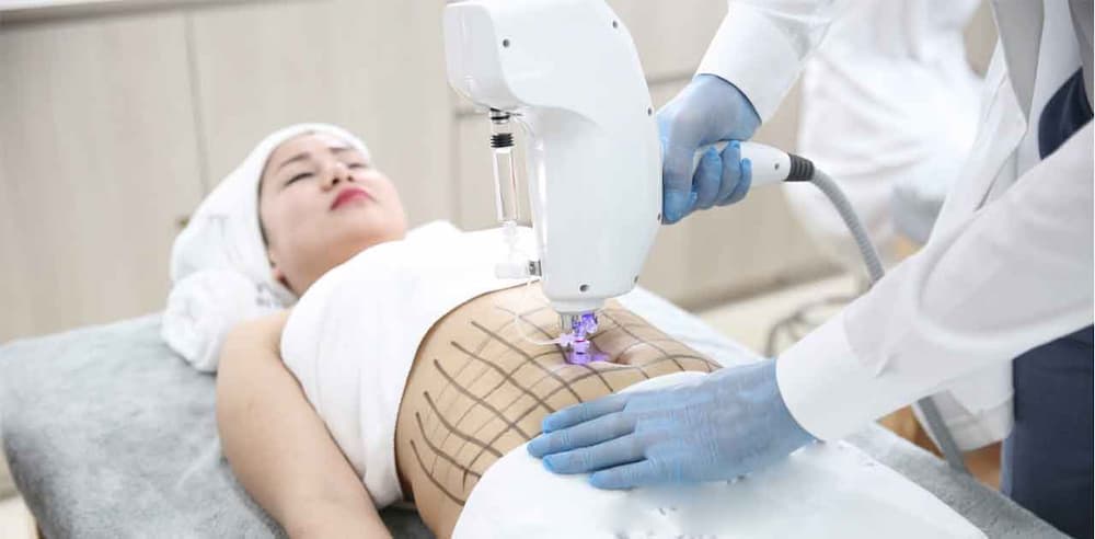Máy giảm béo RF phù hợp với nhu cầu giảm mỡ không phẫu thuật